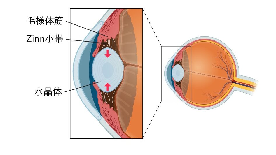 近方視時の毛様体筋と水晶体の模式図。毛様体筋の収縮によりZinn小帯が弛緩し、水晶体が厚く丸くなる様子を示している。