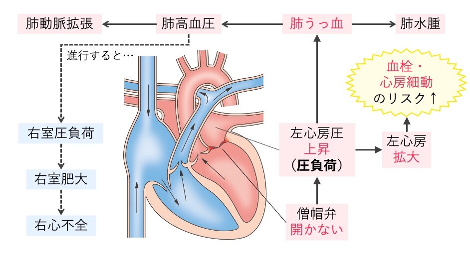 僧帽弁狭窄症の病態図。僧帽弁が開かず左房圧上昇、左房拡大・心房細動リスク、肺うっ血から右心不全へ進行する流れを示す。