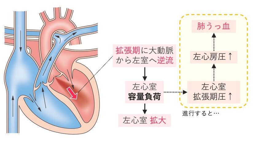 大動脈弁閉鎖不全症の病態図。拡張期に大動脈から左室へ逆流し、容量負荷で左室拡大、肺うっ血につながる流れ。