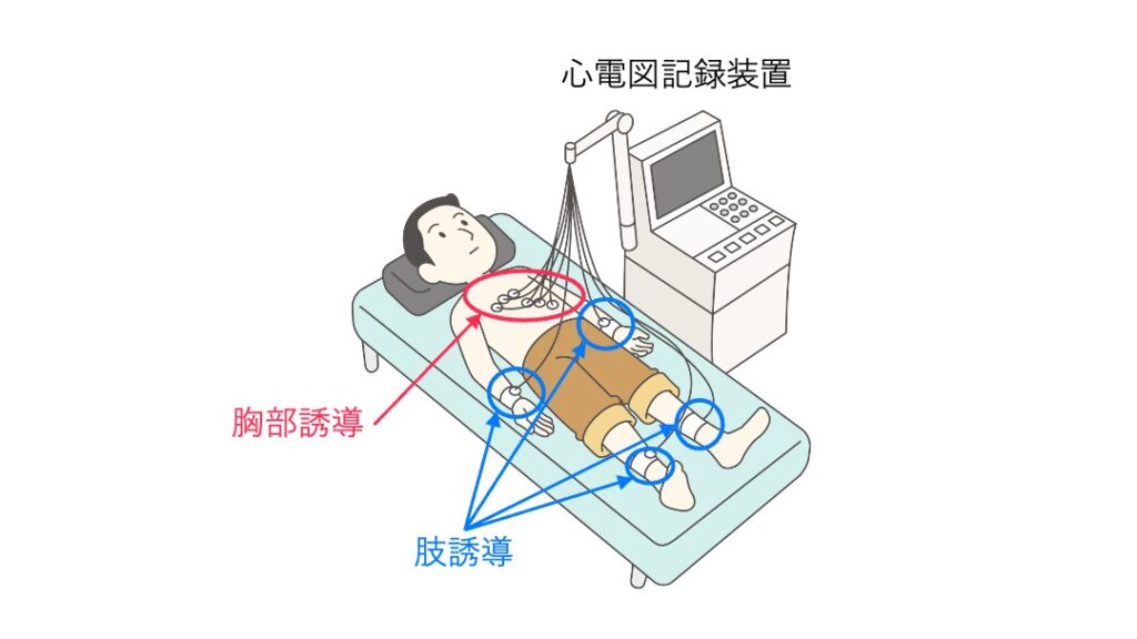 ベッドに横たわる患者に心電図の胸部誘導と肢誘導の電極を装着したイラスト。