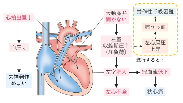大動脈弁狭窄症の病態図。大動脈弁が開かず圧負荷が左室肥大・拡張不全、冠血流低下、狭心痛や失神につながる流れ。