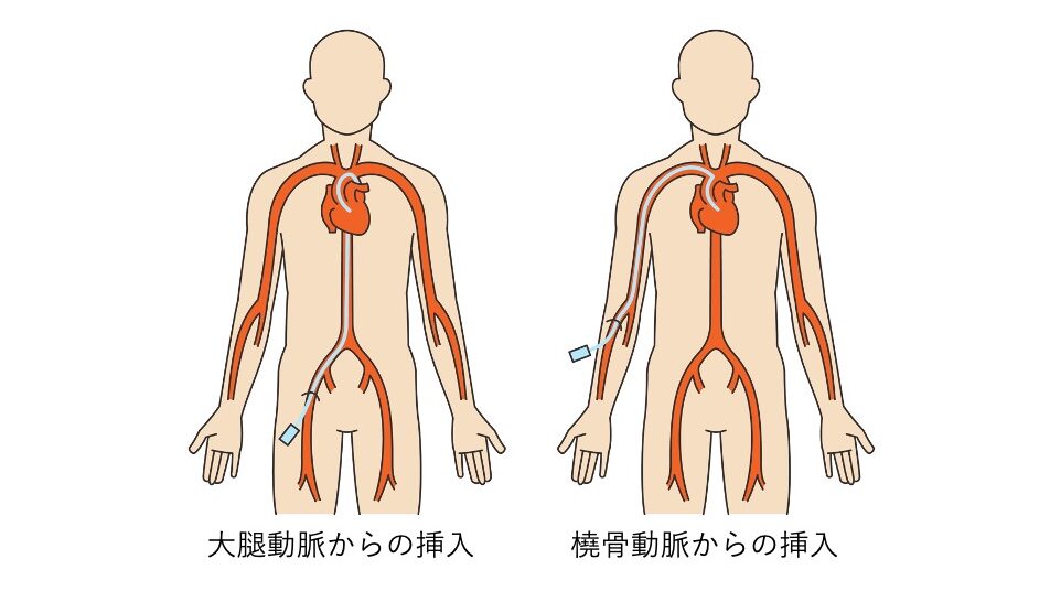 大腿動脈や橈骨動脈から心臓にカテーテルを進める経路を示したイラスト。
