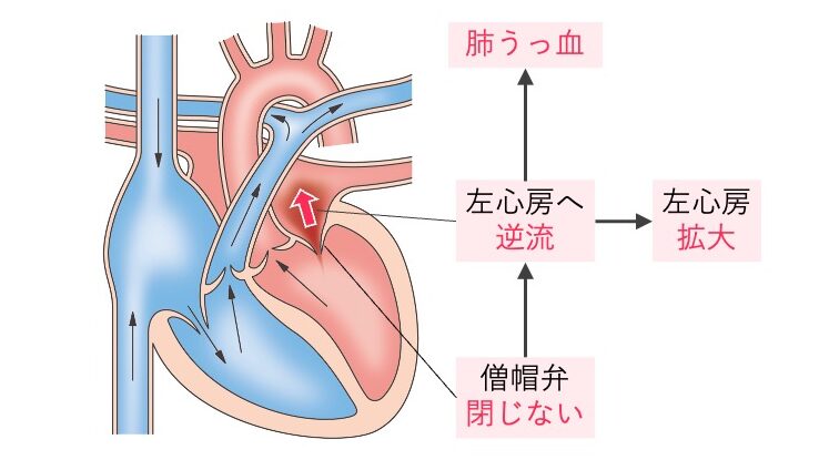 僧帽弁閉鎖不全症の病態図。収縮期に左室から左房へ逆流、左房拡大、肺うっ血へとつながる様子。