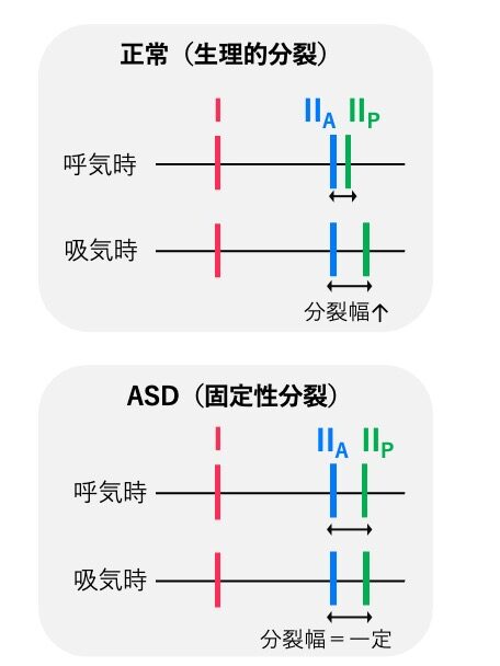 心音図で示すⅡ音の固定性分裂。正常では呼吸によりⅡ音の分裂幅が変動するが、心房中隔欠損症(ASD)では分裂幅が一定となる特徴的な所見。