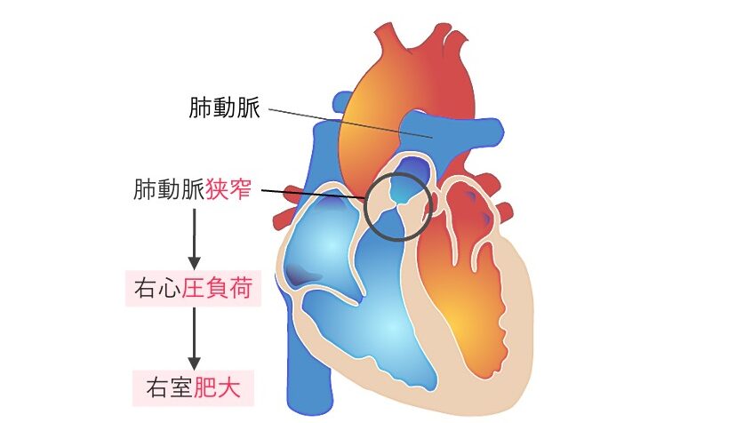 肺動脈狭窄症(PS)の模式図。肺動脈弁の狭窄により右心室が圧負荷を受け、右室肥大をきたす先天性心疾患。