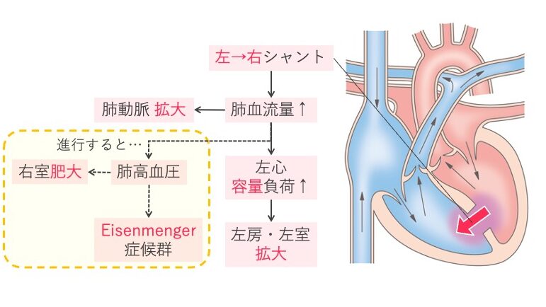 心室中隔欠損症(VSD)の図解。左室から右室への左→右シャントにより肺血流が増加し、肺高血圧や右室肥大を経てアイゼンメンゲル症候群に進展する先天性心疾患の流れを示す。