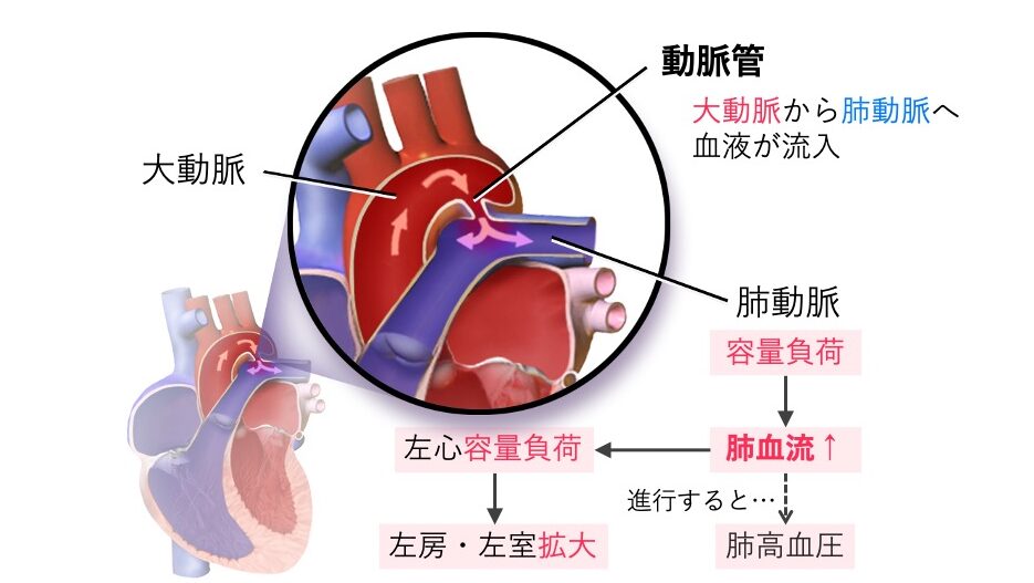 動脈管開存症(PDA)の図。大動脈と肺動脈をつなぐ動脈管が閉鎖せず残存し、左→右シャントによって肺血流増加、左心系容量負荷、肺高血圧を引き起こす先天性心疾患。
