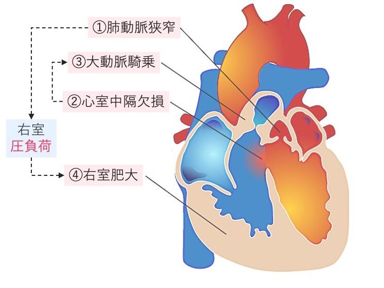 ファロー四徴症(TOF)の図解。①肺動脈狭窄、②心室中隔欠損、③大動脈騎乗、④右室肥大の4つの特徴を持つチアノーゼ性先天性心疾患で、代表的なチアノーゼ型心疾患。