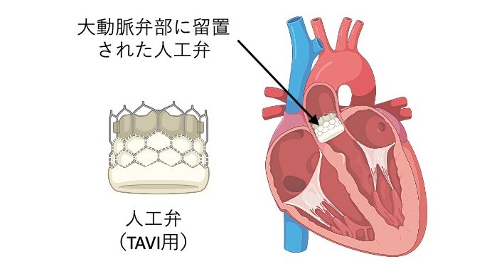 TAVI用の人工弁と、心臓内の大動脈弁部に留置された人工弁の模式図。