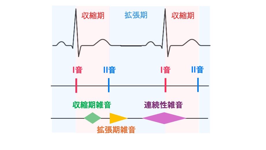 心電図の波形に合わせて、Ⅰ音・Ⅱ音と各種心雑音の出現位置を示した図。