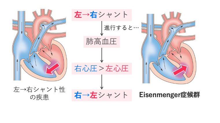 アイゼンメンゲル症候群の模式図。先天性心疾患における左→右シャントが進行し、肺高血圧により右心圧>左心圧となり、右→左シャントへ逆転してチアノーゼが生じる過程を示す。