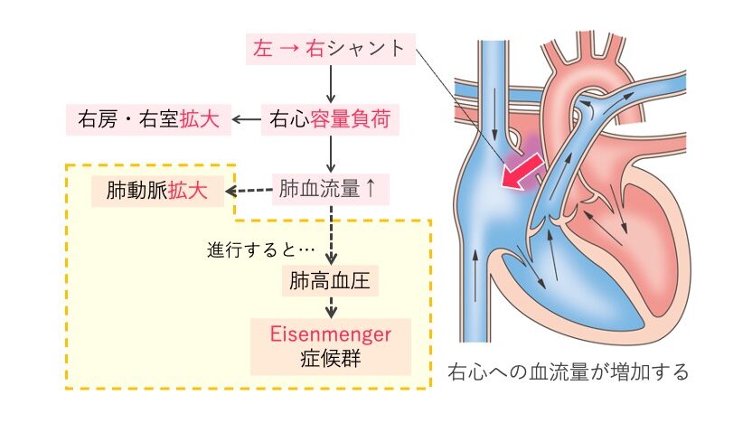 心房中隔欠損症(ASD)の図解。左房から右房への左→右シャントにより右心系の容量負荷と肺血流増加を起こし、進行すると肺高血圧やアイゼンメンゲル症候群へ移行する。