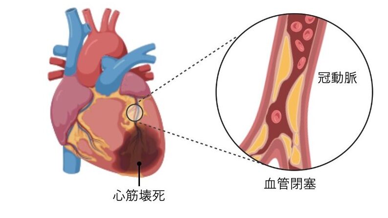 冠動脈の閉塞によって血流が止まり、心筋壊死を起こしている心筋梗塞の模式図。