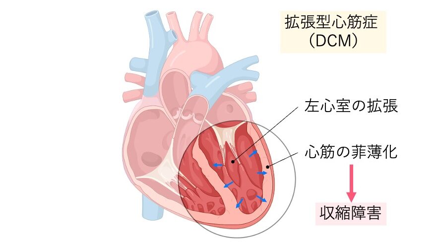 拡張型心筋症(DCM)の断面図。左心室が大きく拡張し、心筋が薄くなって収縮障害を起こす様子を示す。