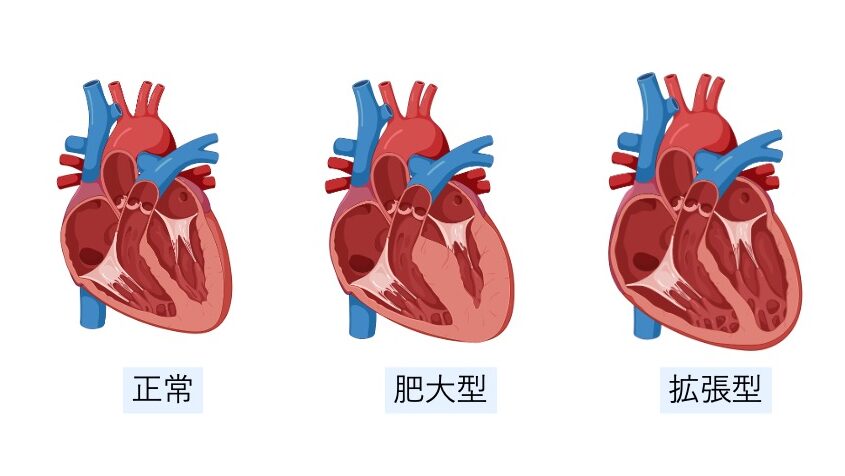 正常心と肥大型心筋症、拡張型心筋症を並べて比較した図。肥大型では心筋壁が厚く、拡張型では心室腔が広く心筋が薄くなっていることを示す。