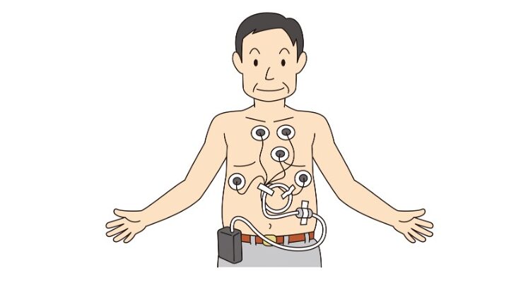 胸部に複数の電極と携帯型装置を装着し、24時間心電図を記録している男性のイラスト。