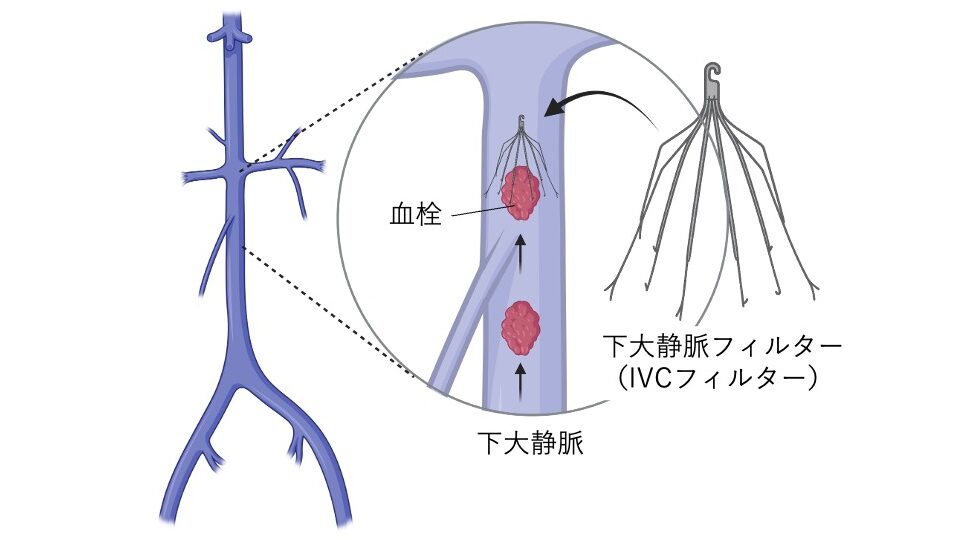下肢の静脈でできた血栓が下大静脈を上行し、腎静脈下部に設置された下大静脈フィルター(IVCフィルター)で捕捉される様子を示す図。
左に全体の静脈構造、右に拡大図があり、血流方向と血栓の流れが矢印で示されている。