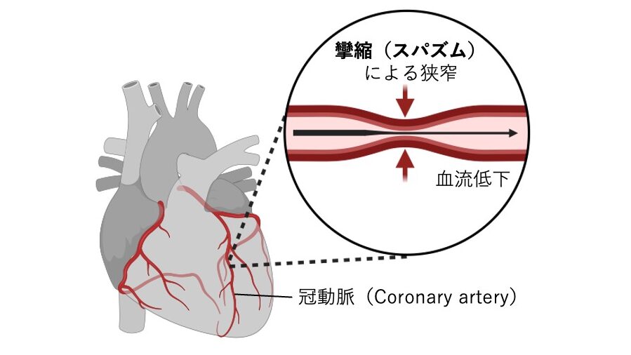 冠動脈の平滑筋がけいれん性に収縮し、一時的に血流が減少している様子を示す図。