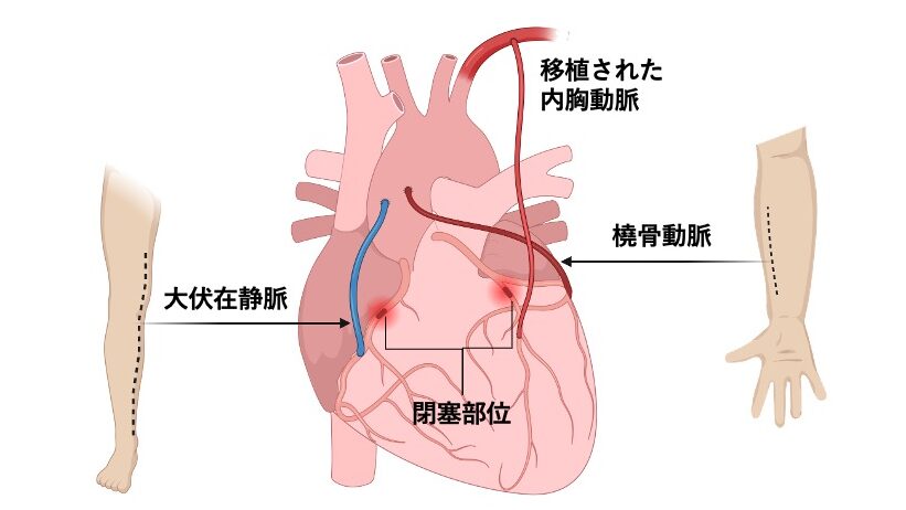 内胸動脈や大伏在静脈を用いて冠動脈閉塞部をバイパスする手術の模式図。