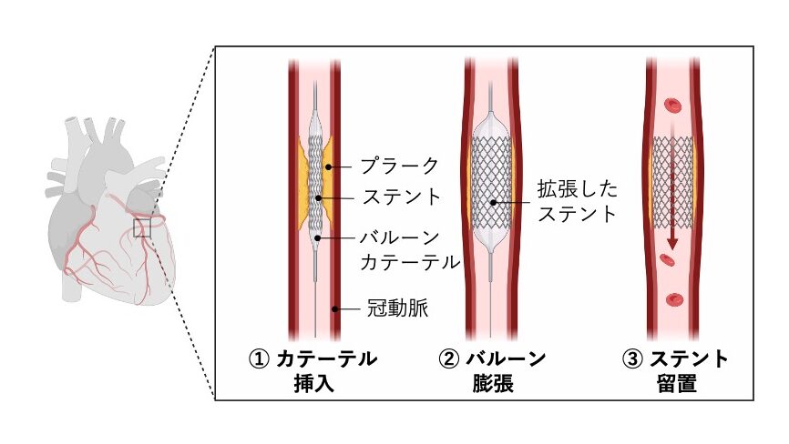経皮的冠動脈インターベンション(PCI)の模式図。カテーテル挿入、バルーン拡張、ステント留置の3段階で冠動脈を広げる手技を示している。