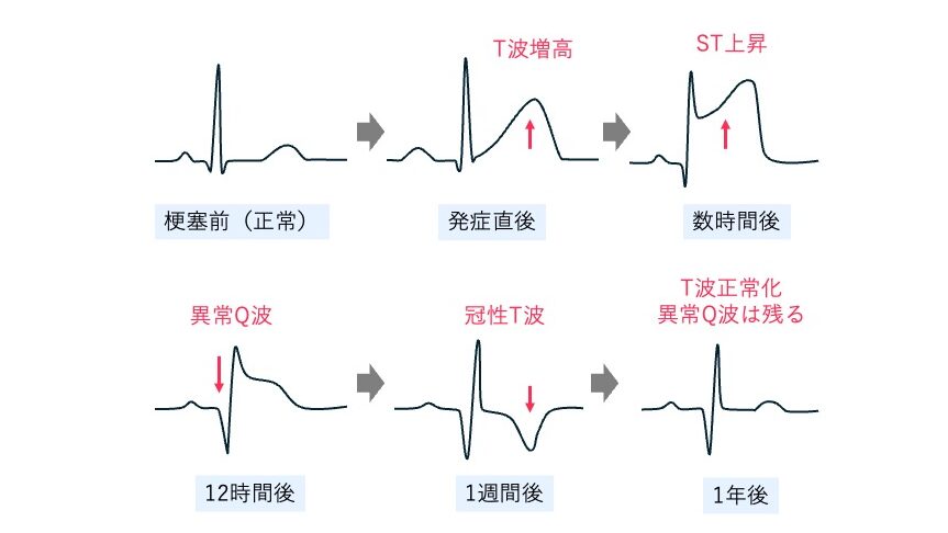 心筋梗塞の発症から1年後までの心電図変化を示す模式図。
ST上昇、異常Q波、冠性T波などの推移が描かれている。