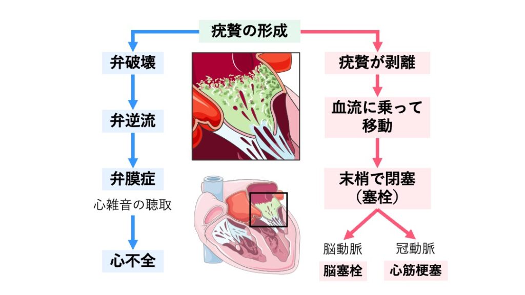 感染性心内膜炎の流れを示す図。弁膜上に形成された疣贅が弁破壊や逆流を起こし、剥離すると血流に乗って脳や冠動脈などに塞栓を生じる様子を示す。
