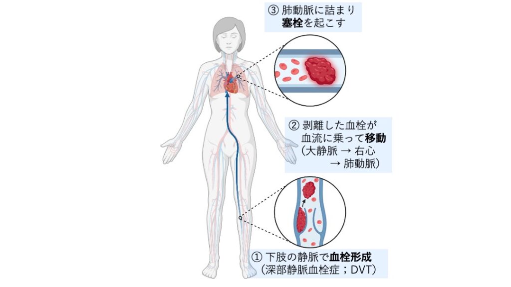下肢の静脈でできた血栓が剥がれて血流に乗り、右心を経由して肺動脈を閉塞するまでの過程を示した図。
深部静脈血栓症(DVT)から肺塞栓症が発生する流れを説明している。