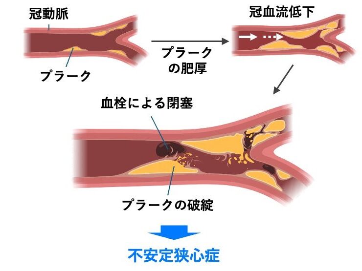 プラーク破裂と血栓形成により冠動脈が閉塞し、不安定狭心症が発症する流れを示す図。