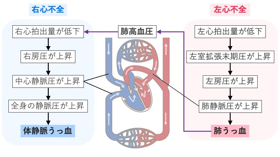 左心不全と右心不全の循環経路の違いを示した図。
左心不全では左室拡張末期圧や肺静脈圧が上昇して肺うっ血を起こし、
右心不全では中心静脈圧や全身静脈圧が上昇して体静脈うっ血を生じることを示している。