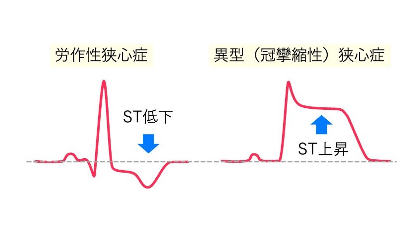 労作性狭心症でST低下、冠攣縮性狭心症でST上昇を示す2種類の心電図波形。