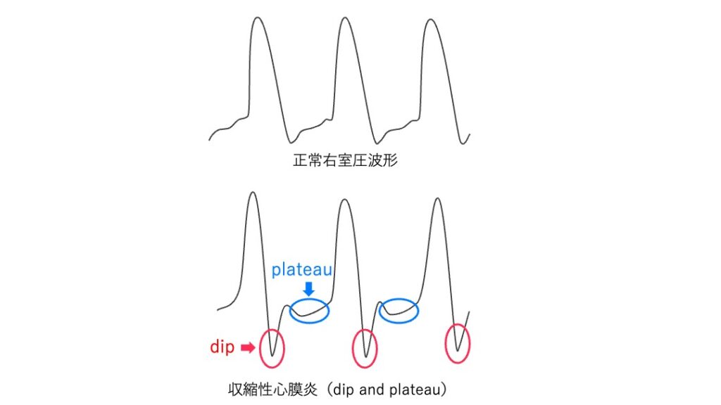 正常右室圧波形と収縮性心膜炎の波形を比較した図。収縮性心膜炎では拡張早期に急な圧下降(dip)がみられ、その後の拡張が制限されて圧が平坦化(plateau)する「dip and plateau」パターンを示す。