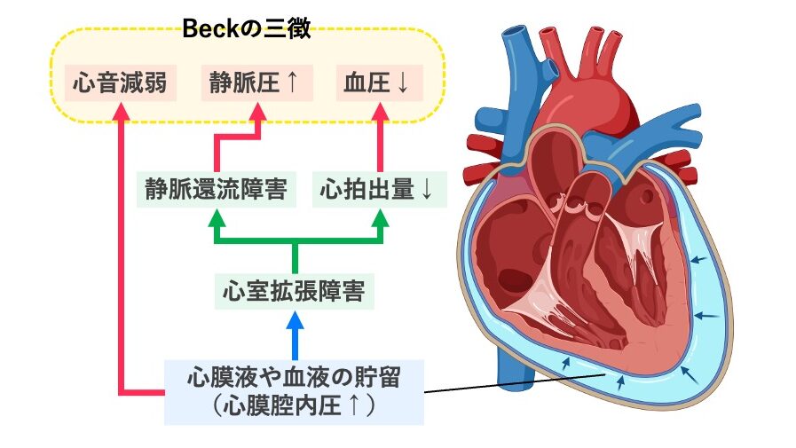 心タンポナーデの病態を示す模式図。心膜腔に液体が貯留して心室の拡張が制限され、静脈還流障害と心拍出量低下を引き起こす。Beckの三徴として心音減弱、頸静脈怒張(静脈圧上昇)、血圧低下が生じることを示す。