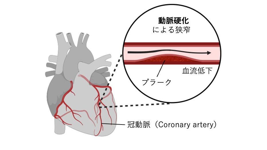 動脈硬化により冠動脈の内腔が狭くなり、プラークの形成と血流低下がみられる模式図。