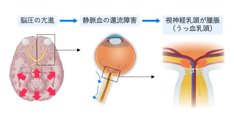 うっ血乳頭の発症機序を示した図。
脳圧の上昇により静脈血の還流が妨げられ、視神経乳頭にうっ血と浮腫が生じる過程を、脳から眼球、視神経の断面図を用いて段階的に示している。