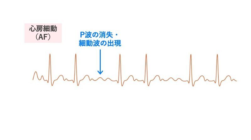 心房細動（AF）の心電図。P波が消失し、細かい細動波（f波）が出現している。RR間隔は不規則で、絶対性不整脈を示す。