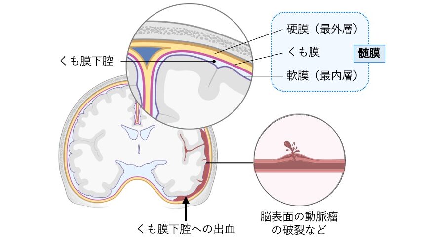 髄膜の構造とくも膜下出血の発生機序を示す図。
硬膜・くも膜・軟膜の3層構造を拡大図で示し、脳表面の動脈瘤が破裂してくも膜下腔に出血が広がる様子を描いている。