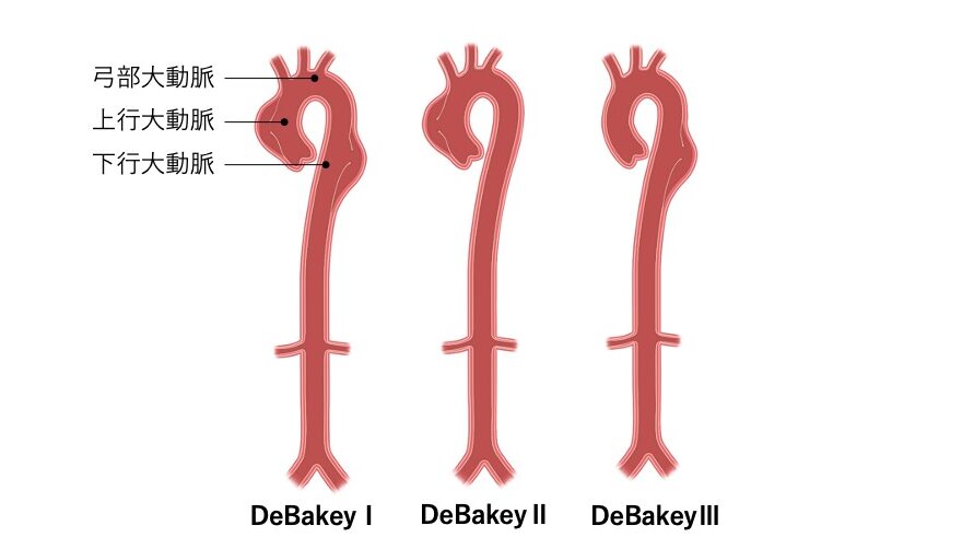 大動脈解離のDeBakey分類を示した図。左からI型、II型、III型が並び、それぞれの大動脈のどの部位に解離が及ぶかを描いている。図の左側には「上行大動脈」「大動脈弓」「下行大動脈」のラベルが配置され、解剖学的位置関係が分かるようになっている。