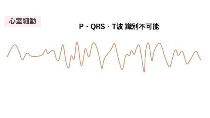 心室細動の心電図。心室が不規則に震え、P波・QRS波・T波の判別が不可能。心拍出量はなく、生命維持が困難なため、速やかな除細動が必要な致死的不整脈である。