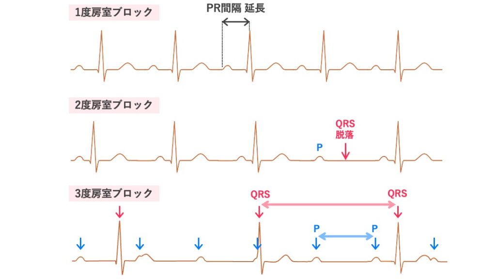 房室ブロックの心電図。上から1度・2度・3度房室ブロックを示す。
1度ではPR間隔が延長、2度ではP波のあとにQRSが脱落、3度では心房と心室のリズムが独立している。