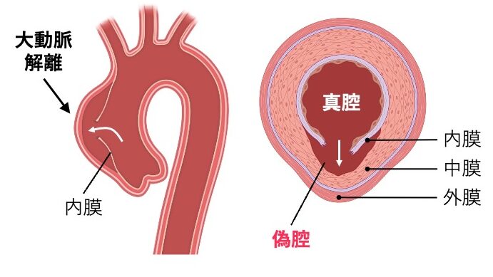 大動脈解離の模式図。左側に大動脈の縦方向のイラストがあり、内膜の亀裂から血液が中膜へ入り込んで偽腔が形成される様子を示す。右側には大動脈の横断面図が描かれ、中央の真腔と、内膜が裂けて生じた偽腔が並走して存在している。大動脈壁の3層構造(内膜・中膜・外膜)も示されている。