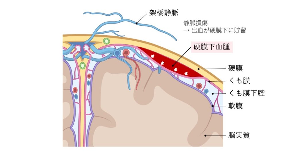 架橋静脈の損傷などにより静脈血が硬膜下腔に拡がり、三日月形に血腫が形成される様子を示したイラスト。硬膜・くも膜・くも膜下腔・軟膜の層構造と、出血が脳表を圧迫している状態が描かれている。