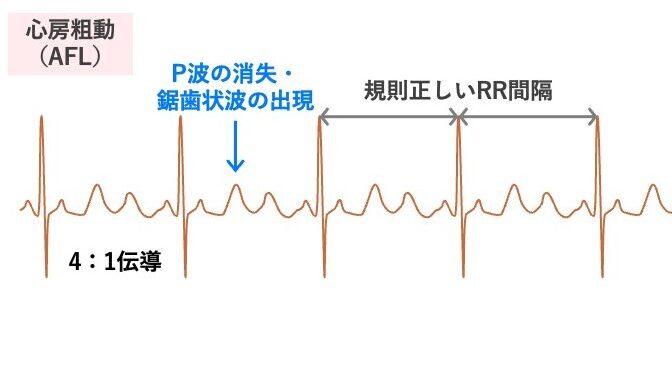心房粗動（AFL）の心電図。P波が消失し、基線に鋸歯状の粗動波（F波）が規則正しくみられる。4：1伝導により、4つの粗動波ごとにQRS波が出現しており、RR間隔は一定である。