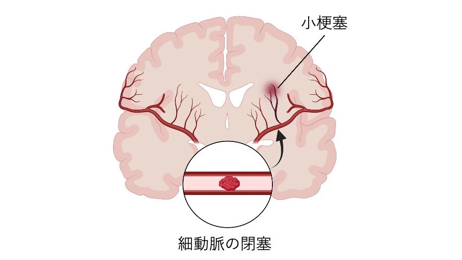 ラクナ梗塞の発生機序を示した図。
脳の断面図で、細動脈の閉塞によって脳深部に小さな梗塞巣（ラクナ）が形成されている様子を描く。
拡大図では、細動脈内が血栓で詰まり血流が遮断されている様子が示されている。