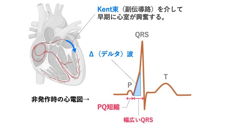 WPW症候群の模式図。心房と心室の間に副伝導路（Kent束）が存在し、心房の興奮が早期に心室へ伝わる。非発作時にはPQ短縮・デルタ波・QRS幅の拡大が見られる。