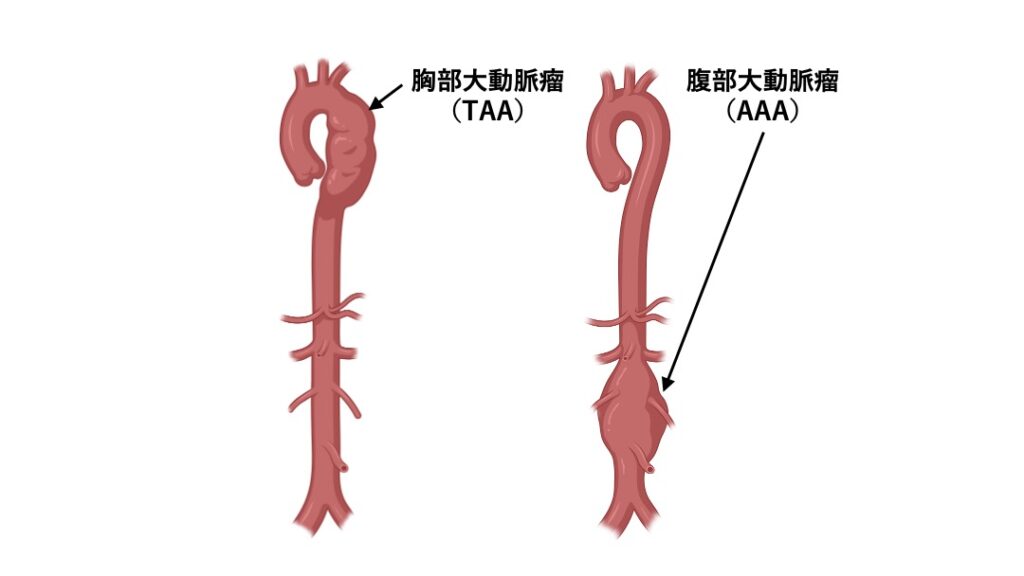 胸部大動脈瘤(TAA)と腹部大動脈瘤(AAA)の位置を示したイラスト。左側に胸部大動脈のこぶ状の拡張(TAA)、右側に腹部大動脈の瘤(AAA)が描かれており、それぞれ矢印で示されている。胸部は上部の大動脈弓付近、腹部は腎動脈分岐より下の腹部大動脈に瘤が形成されている。