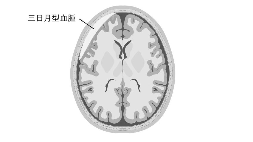 頭部CTの模式図。脳の外側に三日月形の血腫が描かれており、硬膜下血腫に特徴的な半月状の広がりが示されている。