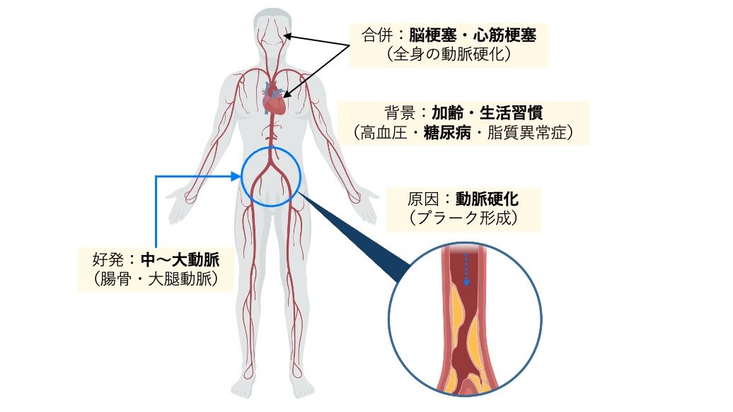 閉塞性動脈硬化症（ASO）の解説図。下肢の腸骨動脈・大腿動脈が狭窄しやすいことを示し、拡大図ではプラーク形成で内腔が狭くなる様子が描かれている。加齢や糖尿病などの生活習慣が背景となり、心筋梗塞・脳梗塞を合併しやすい点が示されている。
