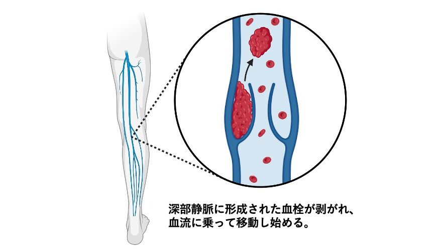 下肢の深部静脈にできた血栓が剝がれ、血流に乗って移動し始める様子を示した図。
拡大図では静脈内の血栓と矢印が描かれ、血栓が血流へ流れていく過程が示されている。