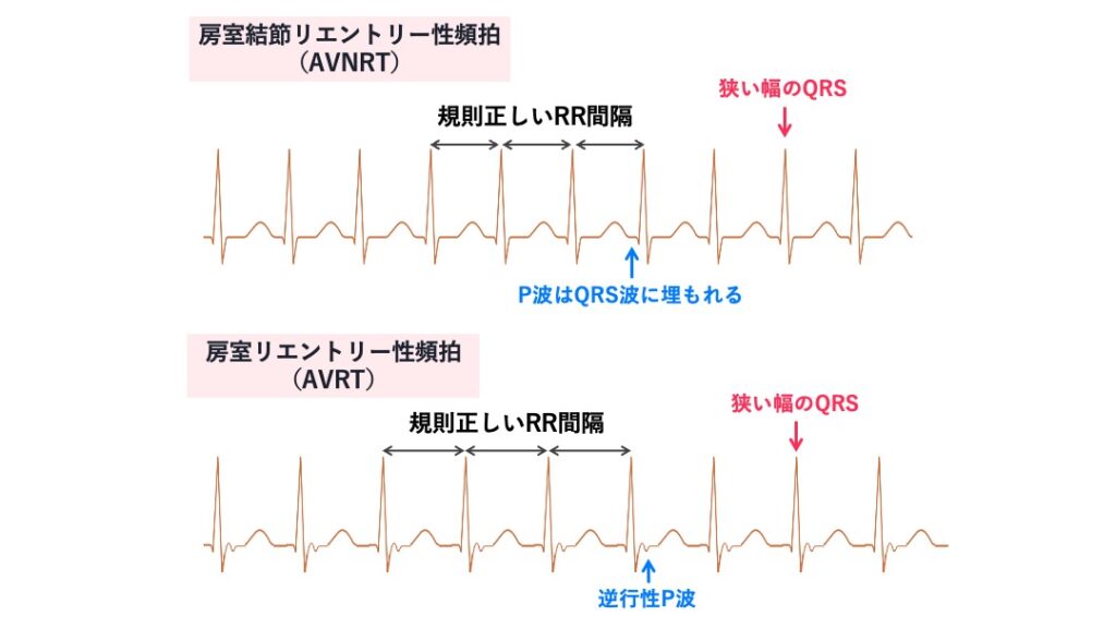 発作性上室性頻拍（PSVT）の心電図。上段の房室結節リエントリー性頻拍（AVNRT）ではP波がQRS波に埋もれ、下段の房室リエントリー性頻拍（AVRT）ではQRS直後に逆行性P波がみられる。いずれも狭い幅のQRS波と規則正しいRR間隔を呈する。