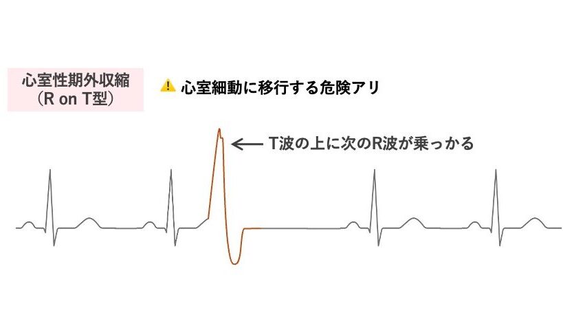 R on T型心室性期外収縮の心電図。T波の上に早期のR波が出現し、代償性休止が短く見られる。不完全代償性休止を伴う危険な型。